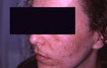 PIGMENTATION DISORDERS - Melasma