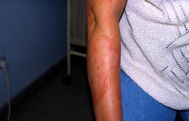 URTICARIA - Urticaria