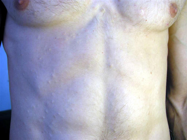 VARIOUS or of UNKNOWN ETIOLOGY DISEASES - Eruptive Vellus Hair Cysts picture | Hellenic Dermatological Atlas - Over 2700 Dermatology pictures VARIOUS or of UNKNOWN ETIOLOGY DISEASES - Eruptive Vellus Hair Cysts picture | Hellenic Dermatological Atlas - Over 2700 Dermatology pictures