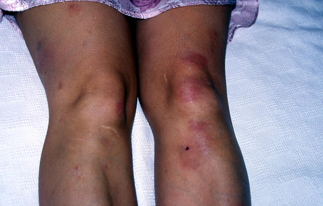 DISEASE OF THE BLOOD AND THE VESSELS – PURPURAS - Erythema nodosum