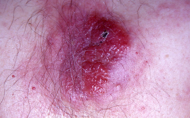 LYMPHOMAS - LYMPHOCYTIC INFILTRATIONS - Mycosis Fungoides LYMPHOMAS - LYMPHOCYTIC INFILTRATIONS - Mycosis Fungoides