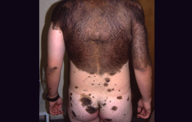 BENIGN SKIN LESIONS, NEVI, CYSTS - Congenital, giant, hairy, melanocytic naevus