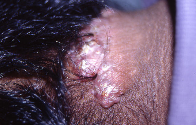 SOFT TISSUE TUMORS - Cheloids SOFT TISSUE TUMORS - Cheloids