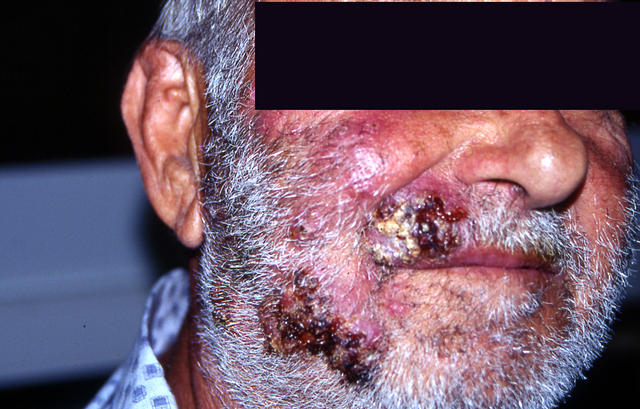 SUPERFICIAL FUNGAL INFECTIONS - Sycosis barbae due to dermatophyte infection