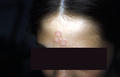 SUPERFICIAL FUNGAL INFECTIONS - Tinea faciale