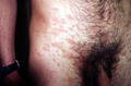 VARIOUS or of UNKNOWN ETIOLOGY DISEASES - Pityriasis rosea