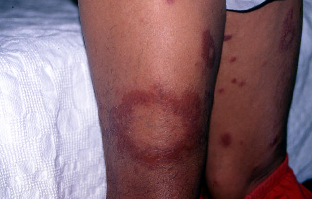 BACTERIAL INFECTIONS - Hansen disease