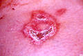 BULLOUS DISEASES - Pemphigus vulgaris