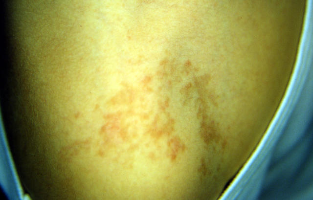 PARASITOSES, BITES - Jelly-fish Dermatitis PARASITOSES, BITES - Jelly-fish Dermatitis