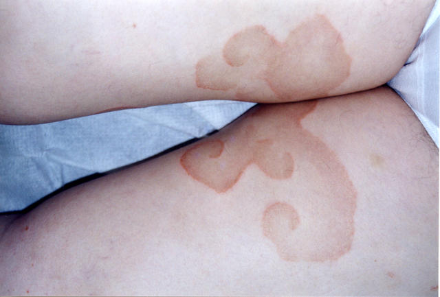 DISEASE OF THE BLOOD AND THE VESSELS – PURPURAS - Erythema annulare centrifugum