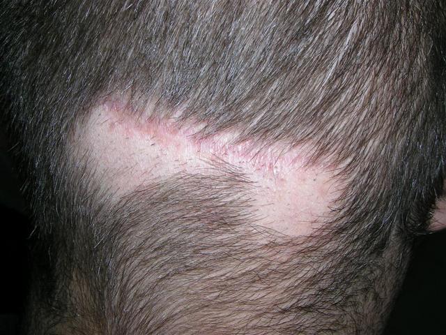 HAIR DISEASES - Alopecia Areata