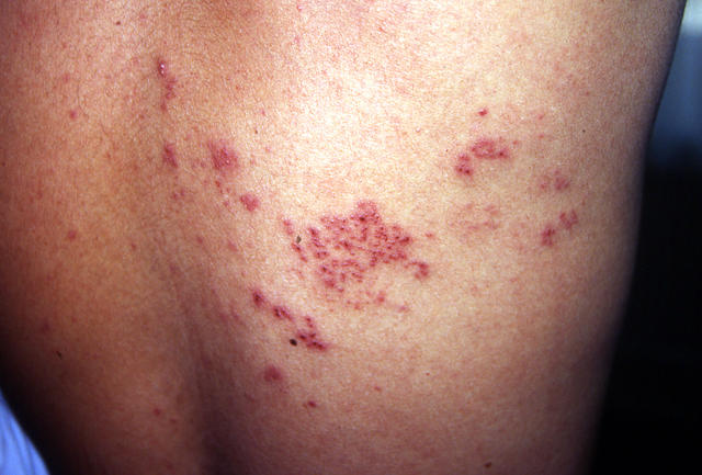 VIRAL INFECTIONS - Herpes Zoster VIRAL INFECTIONS - Herpes Zoster