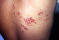 VIRAL INFECTIONS - Herpes Zoster