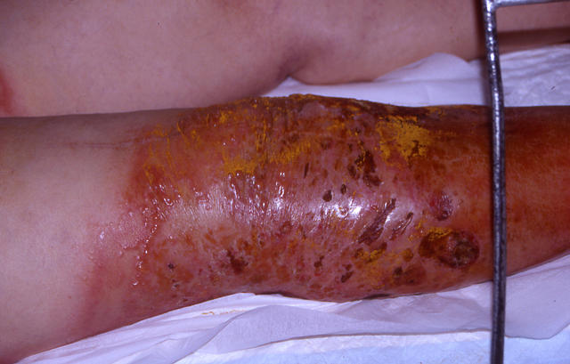 BACTERIAL INFECTIONS - Erysipelas BACTERIAL INFECTIONS - Erysipelas