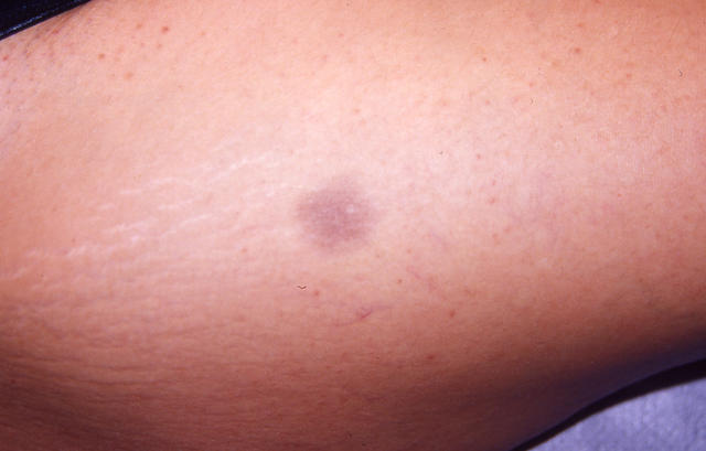 DRUG ERUPTIONS - Fixed drug eruption DRUG ERUPTIONS - Fixed drug eruption