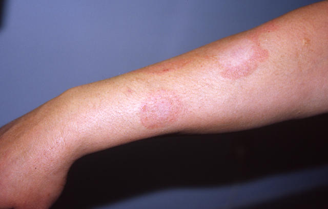 URTICARIA - Urticaria