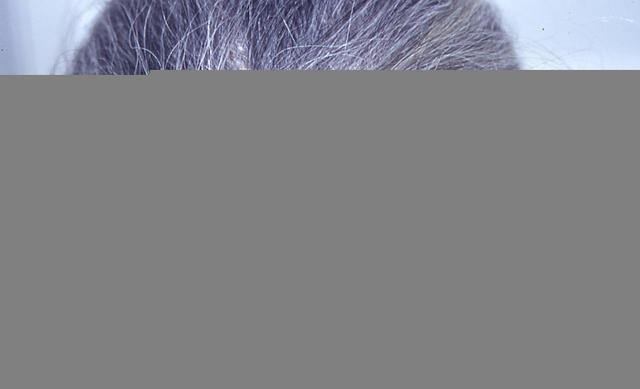 SUPERFICIAL FUNGAL INFECTIONS - Tinea capitis in an adult SUPERFICIAL FUNGAL INFECTIONS - Tinea capitis in an adult