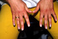 NAIL DISEASES - Leukonychia