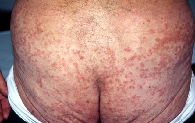 DRUG ERUPTIONS - Drug eruption DRUG ERUPTIONS - Drug eruption