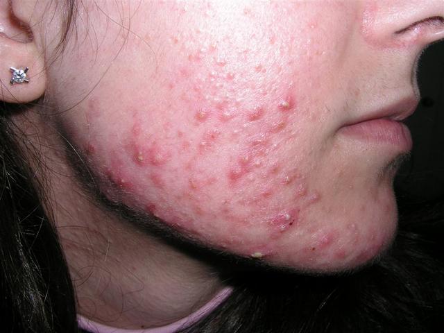 DISEASES OF THE SEBACEOUS GLANDS - Acne, inflammatory of the face DISEASES OF THE SEBACEOUS GLANDS - Acne, inflammatory of the face