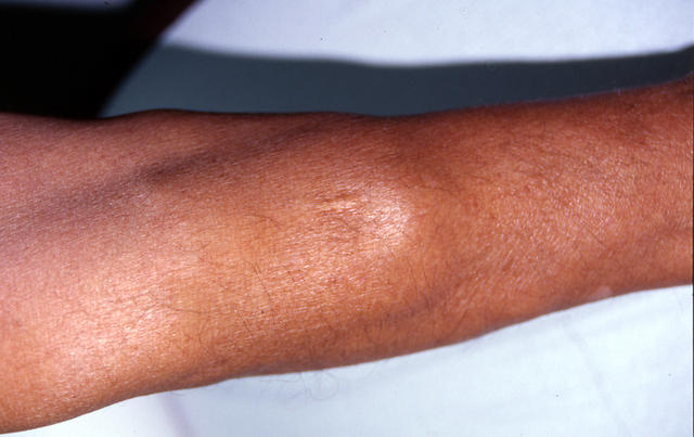 VARIOUS or of UNKNOWN ETIOLOGY DISEASES - Multiple lipomas syndrome