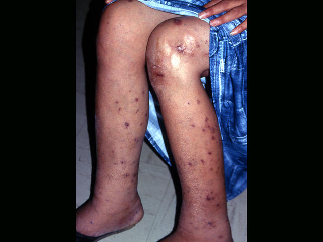 BACTERIAL INFECTIONS - Hansen disease BACTERIAL INFECTIONS - Hansen disease