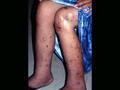 BACTERIAL INFECTIONS - Hansen disease