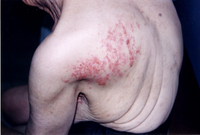 VIRAL INFECTIONS - Herpes Zoster