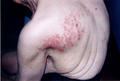 VIRAL INFECTIONS - Herpes Zoster