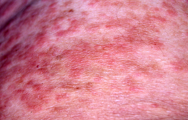 DRUG ERUPTIONS - Drug eruption DRUG ERUPTIONS - Drug eruption