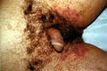 BACTERIAL INFECTIONS - Impetigo