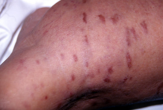 SOFT TISSUE TUMORS - Kaposi sarcoma SOFT TISSUE TUMORS - Kaposi sarcoma