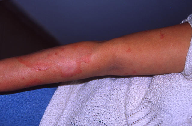 URTICARIA - Urticaria