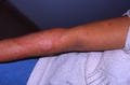 URTICARIA - Urticaria