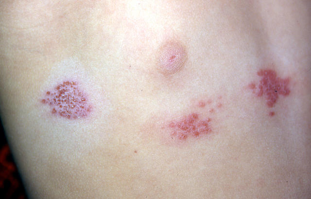 VIRAL INFECTIONS - Herpes Zoster