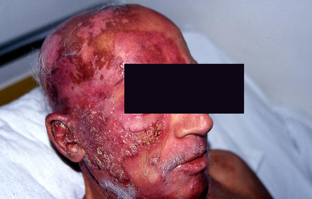 LYMPHOMAS - LYMPHOCYTIC INFILTRATIONS - Mycosis Fungoides