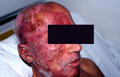 LYMPHOMAS - LYMPHOCYTIC INFILTRATIONS - Mycosis Fungoides