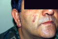 VARIOUS or of UNKNOWN ETIOLOGY DISEASES - Garnuloma faciale