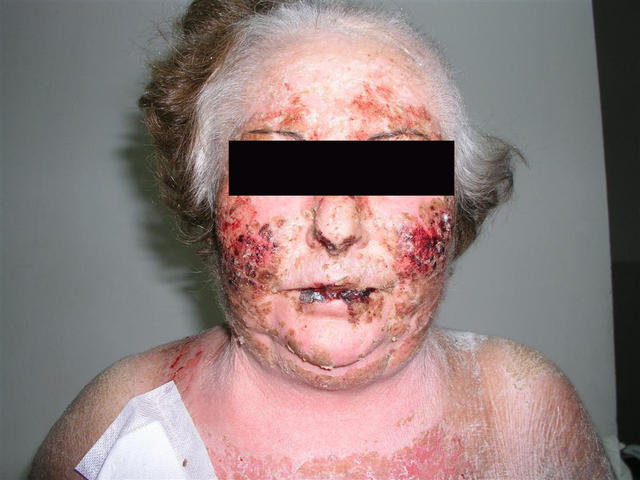 DRUG ERUPTIONS - Toxic epidermal necrolysis (Stevens-Johnson syndrome)