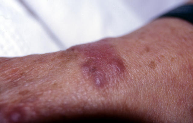 SOFT TISSUE TUMORS - Kaposi sarcoma SOFT TISSUE TUMORS - Kaposi sarcoma