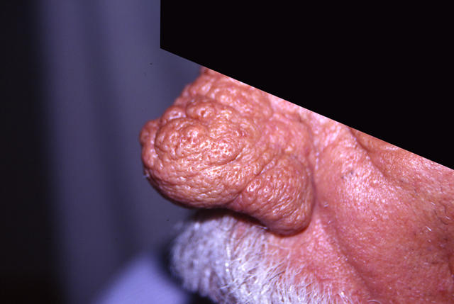 DISEASES OF THE SEBACEOUS GLANDS - Rhinophyma DISEASES OF THE SEBACEOUS GLANDS - Rhinophyma
