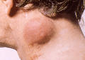 SKIN LESIONS IN HIV-AIDS PATIENTS - Lymphoma, cutaneous