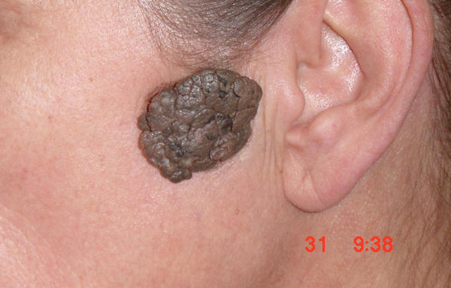 BENIGN SKIN LESIONS, NEVI, CYSTS - Seborrheic keratosis