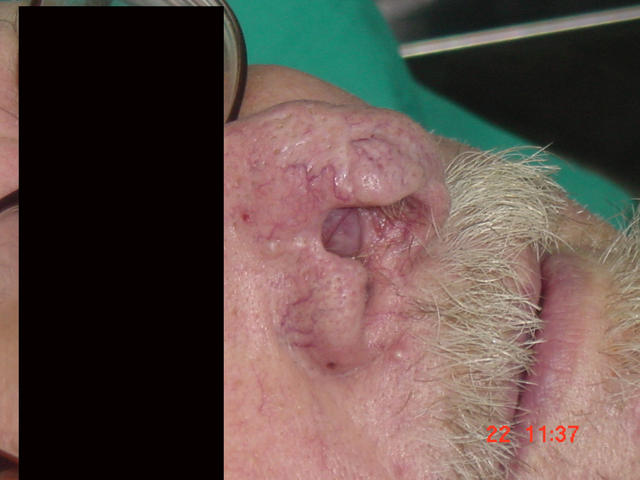 MALIGNANT LESIONS - Basal Cell Carcinoma