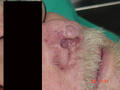 MALIGNANT LESIONS - Basal Cell Carcinoma