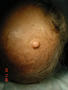 BENIGN SKIN LESIONS, NEVI, CYSTS - Sebaceous cysts