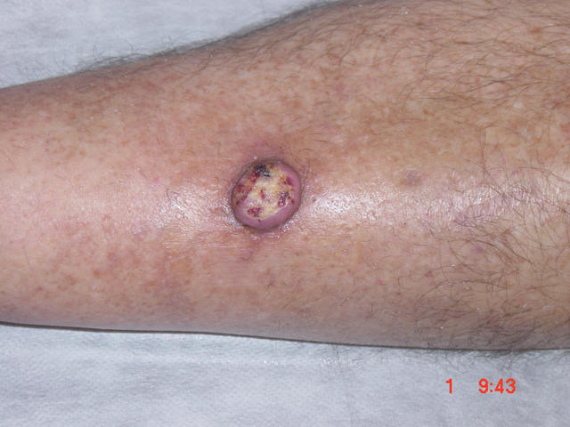 MALIGNANT LESIONS - Keratoacanthoma