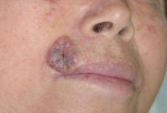 MALIGNANT LESIONS - Basal Cell Carcinoma