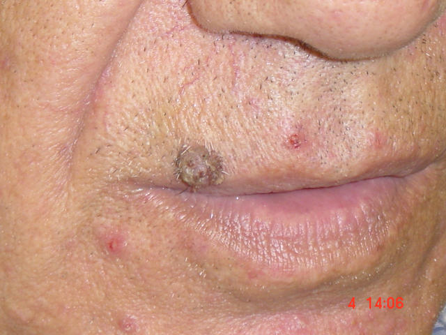 MALIGNANT LESIONS - Basal Cell Carcinoma