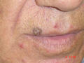 MALIGNANT LESIONS - Basal Cell Carcinoma